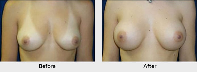Breast Augmentation Before After Photos Charlotte, NC