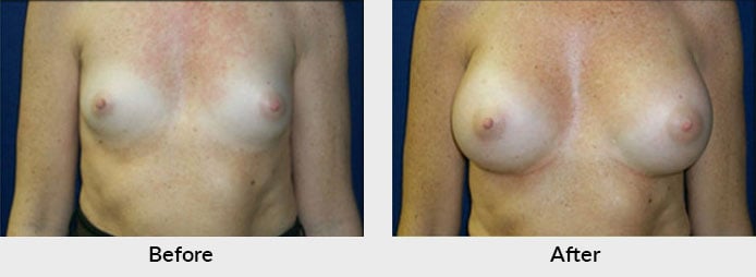 Breast Implant Before After Photos Charlotte, NC