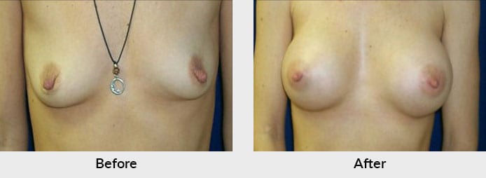 Breast Augmentation Charlotte, NC