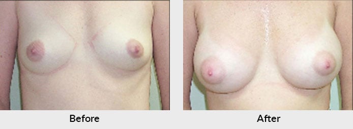 Breast Implant Patient Charlotte, NC