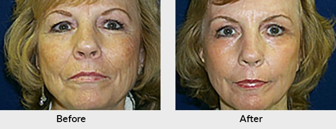 Laser Skin Resurfacing Before & After Photo in Charlotte, NC