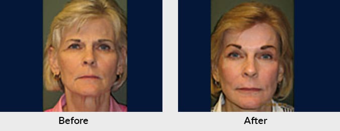 Laser Skin Treatment in Charlotte, NC