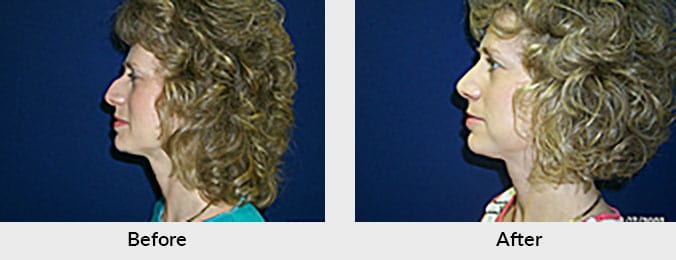 Rhinoplasty Patient Charlotte, NC