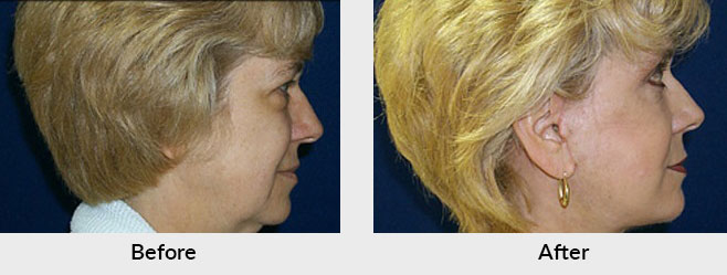 Facelift Before After Photos in Charlotte, NC