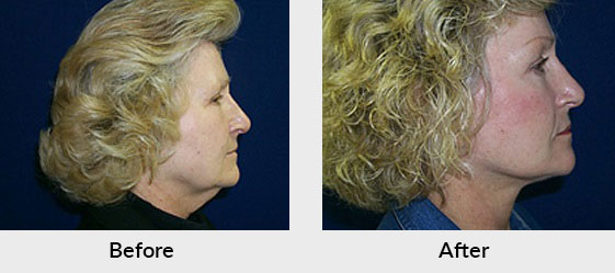 Facelift Patient in Charlotte, NC