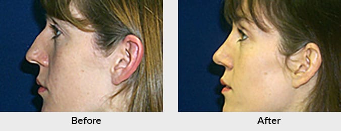 Rhinoplasty Charlotte, NC