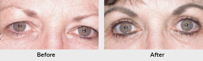 Eyelid Surgery Before After Photos in Charlotte, NC
