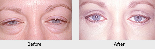 Blepharoplasty Patient in Charlotte, NC
