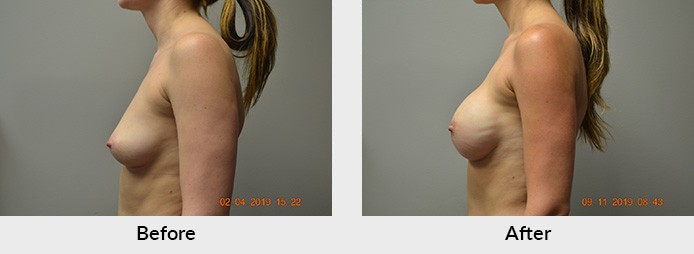 Breast Reconstruction Surgeon Charlotte NC