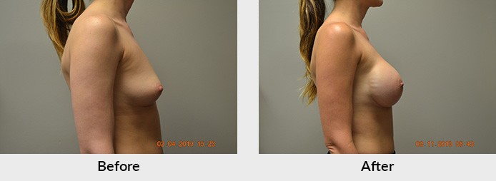 Breast Reconstruction Implant Patient Charlotte NC