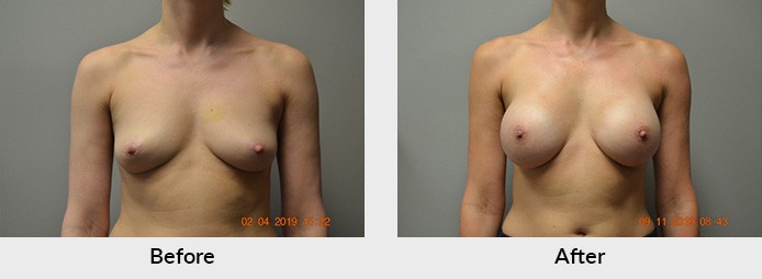 Breast Reconstruction Charlotte NC