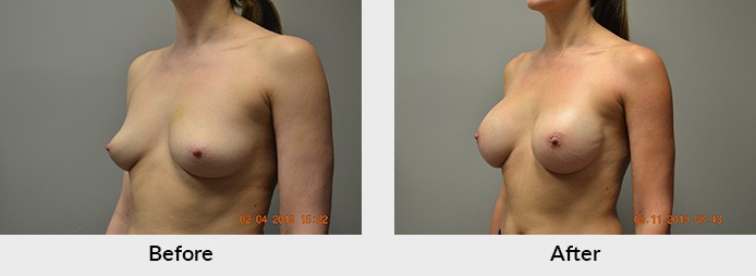 Breast Reconstruction Patient Charlotte NC