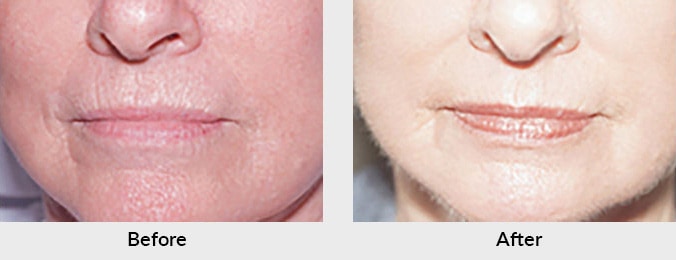 Laser Skin Resurfacing in Charlotte, NC