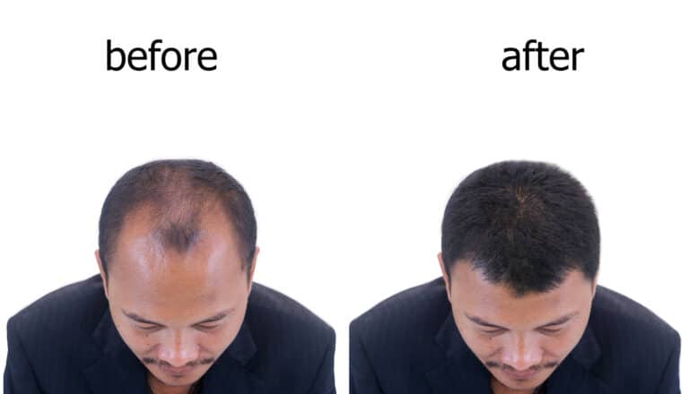 Hair transplants in Charlotte, NC