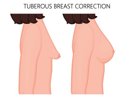 Tubular Breast Correction in Charlotte