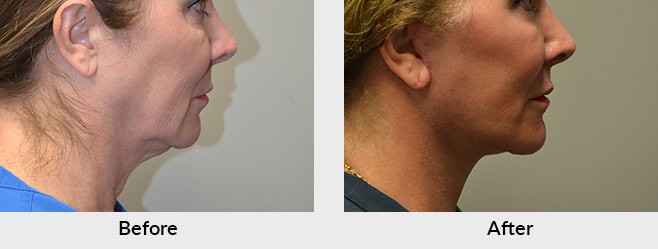 Facelift Before After Photos in Charlotte, NC