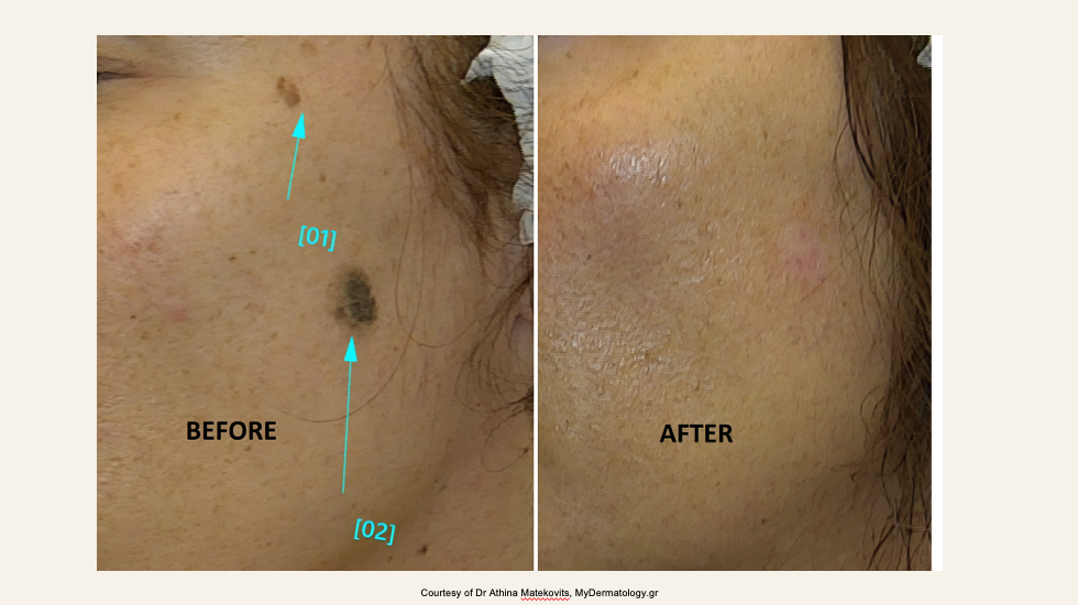 What EDGE ONE Treats