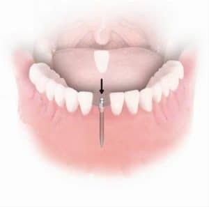 Process of Mini Dental Implants