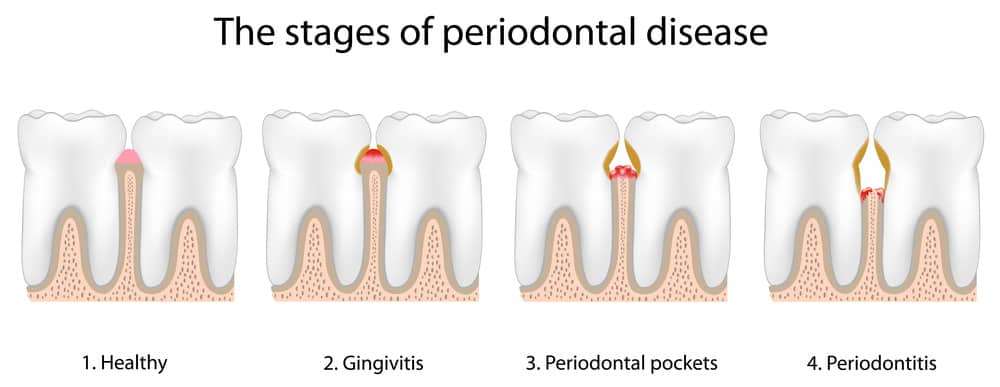 Gingivitis Periodontal Therapy