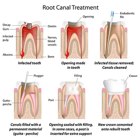 Single-visit root canal Toledo