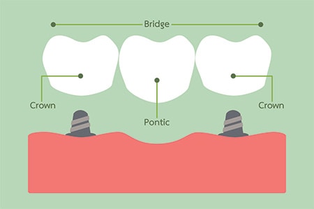 Dental bridges procedure Toledo 