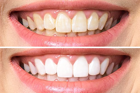 Professional teeth whitening Toledo