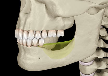 mini dental implants Sylvania
