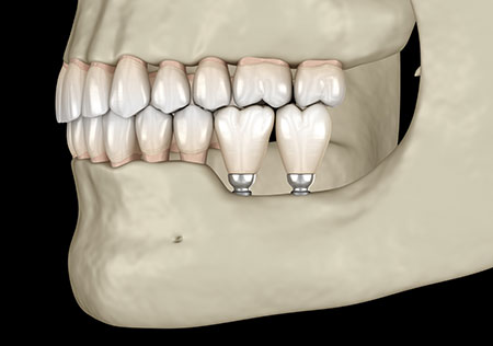 Sylvania dental implant specialist