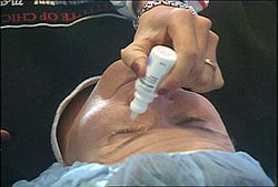 Se limpiará el área alrededor de sus ojos y una gaza esterilizada se colocará alrededor de los mismos.