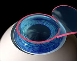 Illustration of Los Angeles All Laser LASIK treatment for nearsightedness