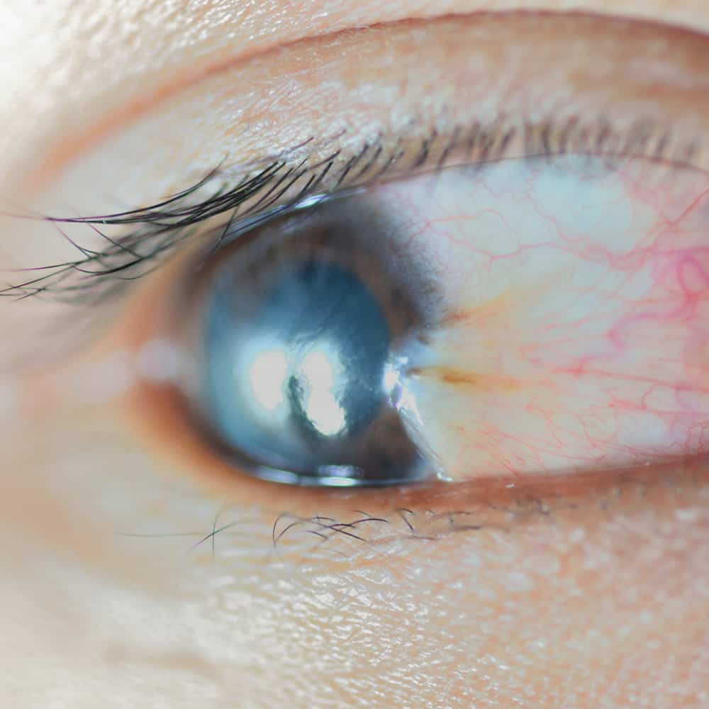 Can Pterygium Reoccur after Removal?