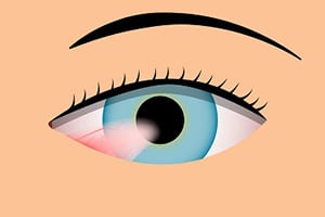 Pterygium Treatment in Norwalk