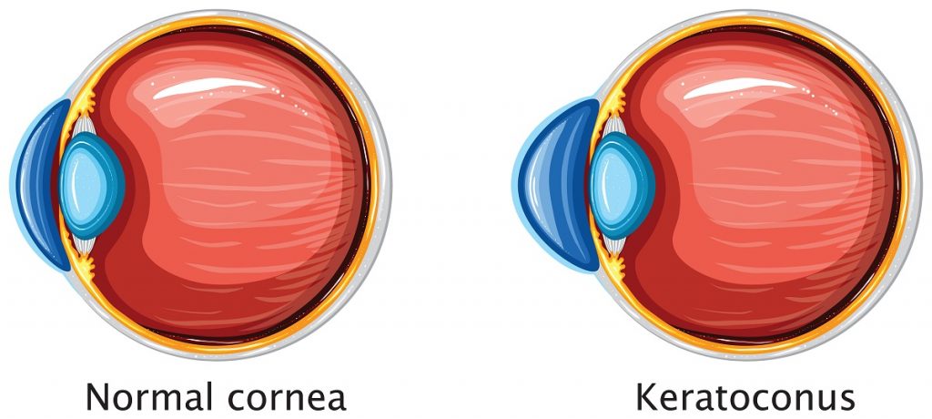 Cornea Affected by Keratoconus Infographic
