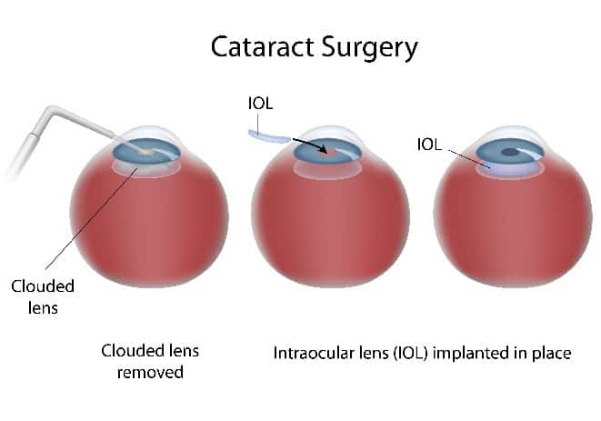 Lente intraocular Los Ángeles