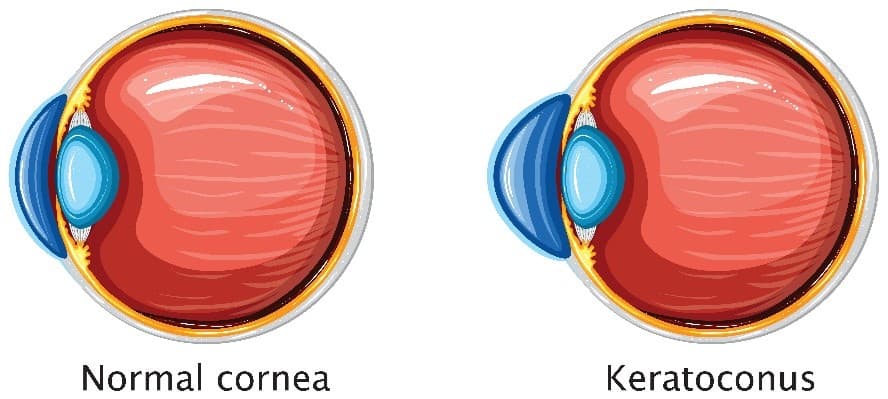 Infografía sobre la córnea afectada por el queratocono