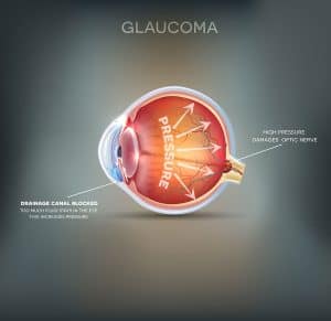 Glaucoma versus cataratas Riverside