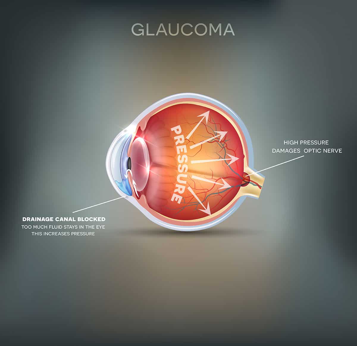 Glaucoma vs Cataracts Los Angeles & Santa Clarita