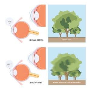 Los Angeles keratoconus treatment