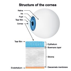 corneal collagen cross-linking Los Angeles