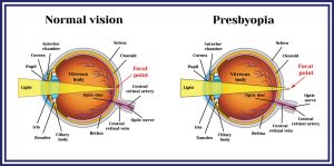 Refractive lens exchange Los Angeles 