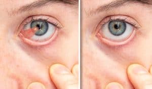 Pterygium removal Los Angeles