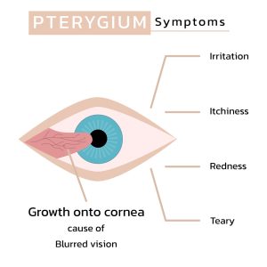 Los Angeles pterygium surgery