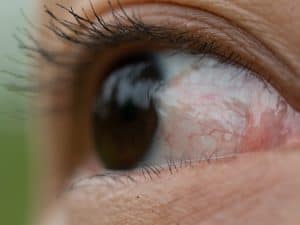 Pterygium Treatment West Covina