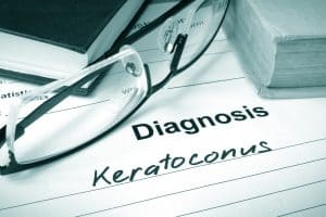 Keratoconus Treatment Pasadena