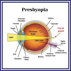 Presbyopia Treatment Sherman Oaks