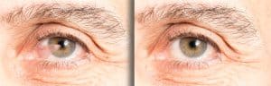 Pterygium Treatment Sherman Oaks