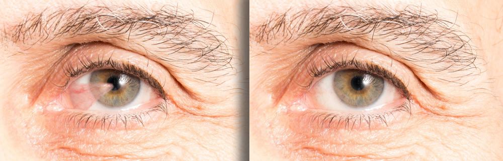 Lasik Burbank Cataract Surgery Burbank Dry Eye Treatment