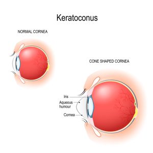 Keratoconus Treatment Sherman Oaks