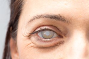 Cataract Surgery in Montebello