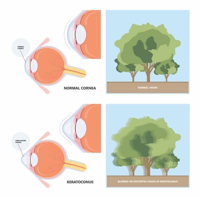 Cross-linking colágeno corneal Los Ángeles - Tratamiento de queratocono